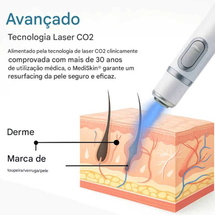 MediSkin Laser – Elimine Manchas e Verrugas | Resultados Rápidos