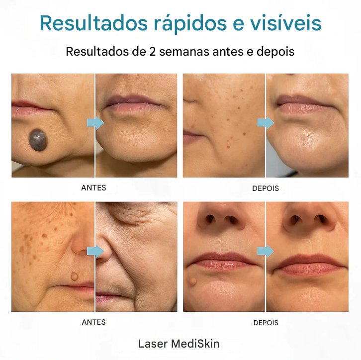 MediSkin Laser – Elimine Manchas e Verrugas | Resultados Rápidos
