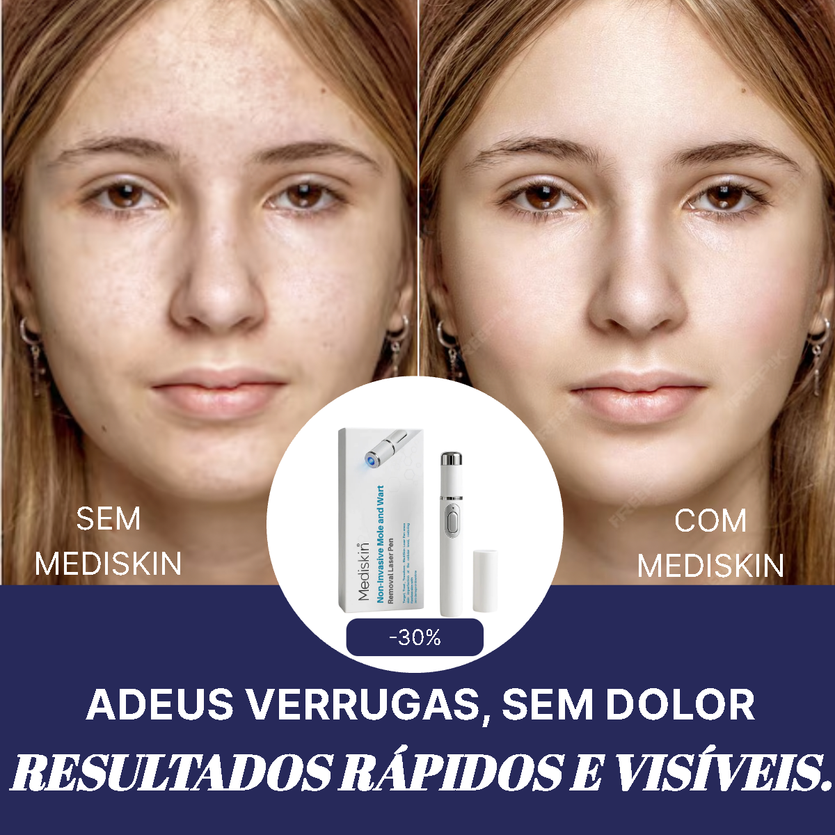 MediSkin Laser – Elimine Manchas e Verrugas | Resultados Rápidos