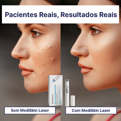 MediSkin Laser – Elimine Manchas e Verrugas | Resultados Rápidos