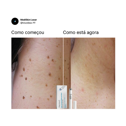 MediSkin Laser – Elimine Manchas e Verrugas | Resultados Rápidos